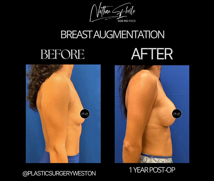 Breast Augmentation before and after case 250, actual patient at Weston Center for Plastic Surgery