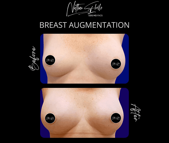 Breast Augmentation before and after case 252, actual patient at Weston Center for Plastic Surgery
