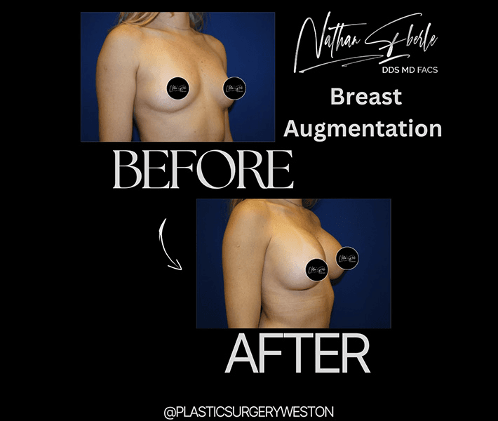 Breast Augmentation before and after case 257, actual patient at Weston Center for Plastic Surgery