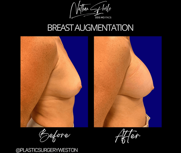 Breast Augmentation before and after case 26, actual patient at Weston Center for Plastic Surgery
