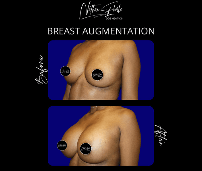 Breast Augmentation before and after case 263, actual patient at Weston Center for Plastic Surgery
