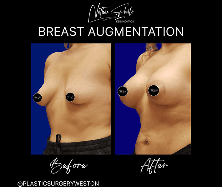 Breast Augmentation before and after case 270, actual patient at Weston Center for Plastic Surgery
