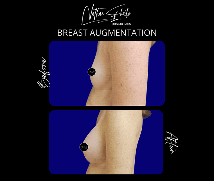 Breast Augmentation before and after case 271, actual patient at Weston Center for Plastic Surgery
