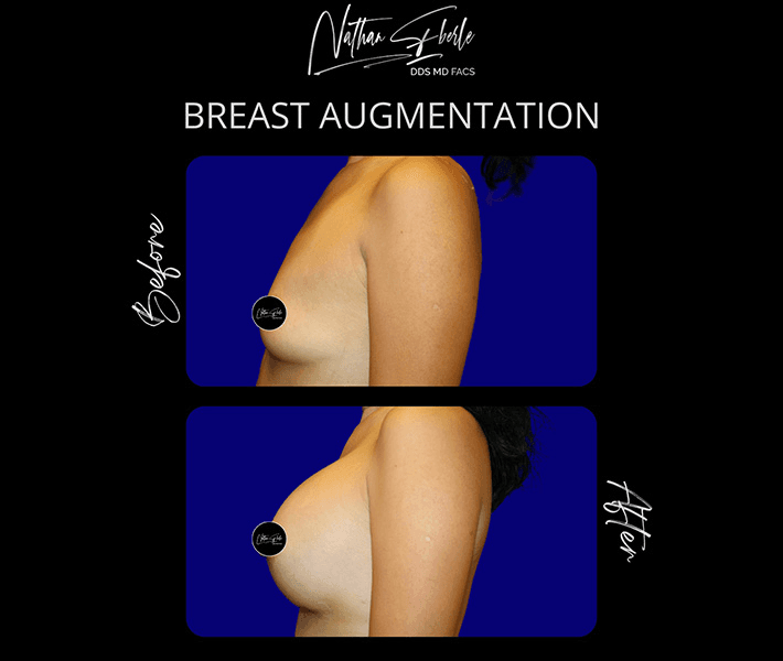 Breast Augmentation before and after case 272, actual patient at Weston Center for Plastic Surgery