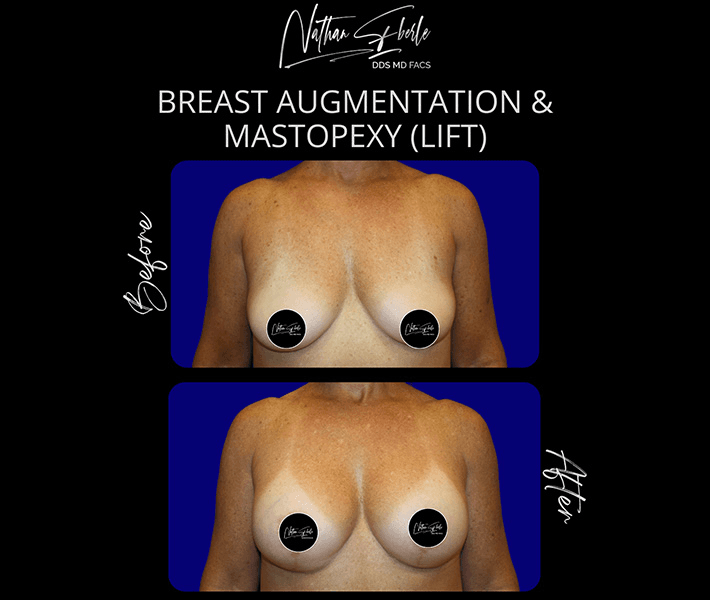 Breast Augmentation before and after case 276, actual patient at Weston Center for Plastic Surgery