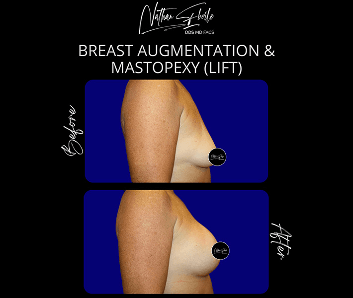 Breast Augmentation before and after case 277, actual patient at Weston Center for Plastic Surgery