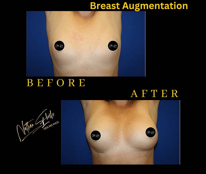 Breast Augmentation before and after case 28, actual patient at Weston Center for Plastic Surgery