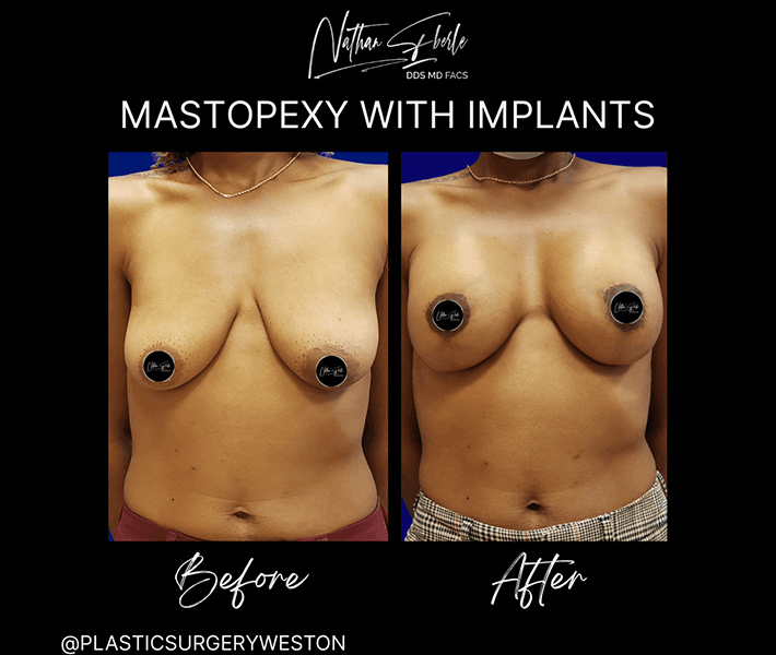 Breast Augmentation before and after case 281, actual patient at Weston Center for Plastic Surgery
