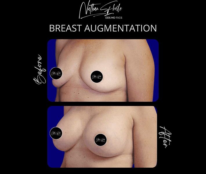 Breast Augmentation before and after case 285, actual patient at Weston Center for Plastic Surgery