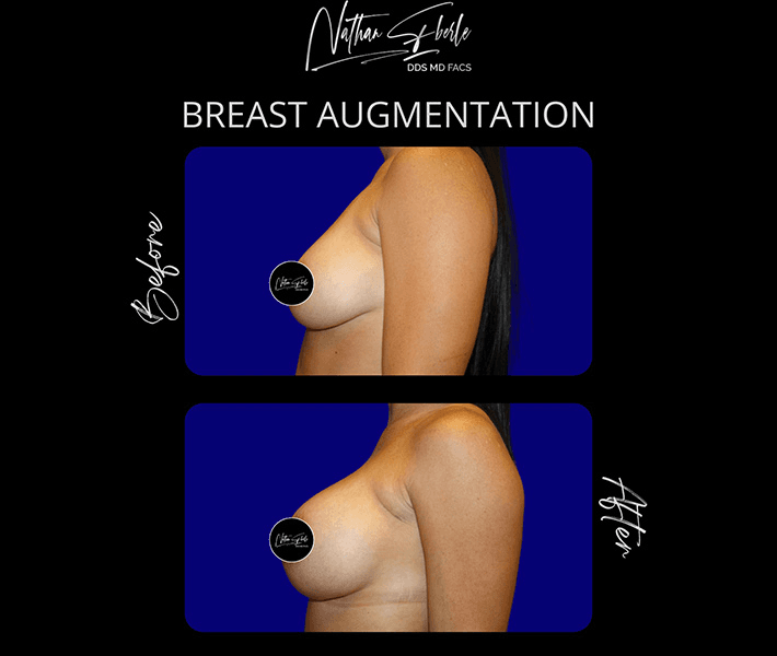 Breast Augmentation before and after case 290, actual patient at Weston Center for Plastic Surgery