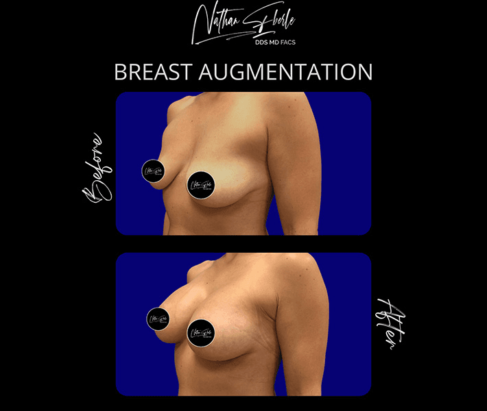 Breast Augmentation before and after case 295, actual patient at Weston Center for Plastic Surgery