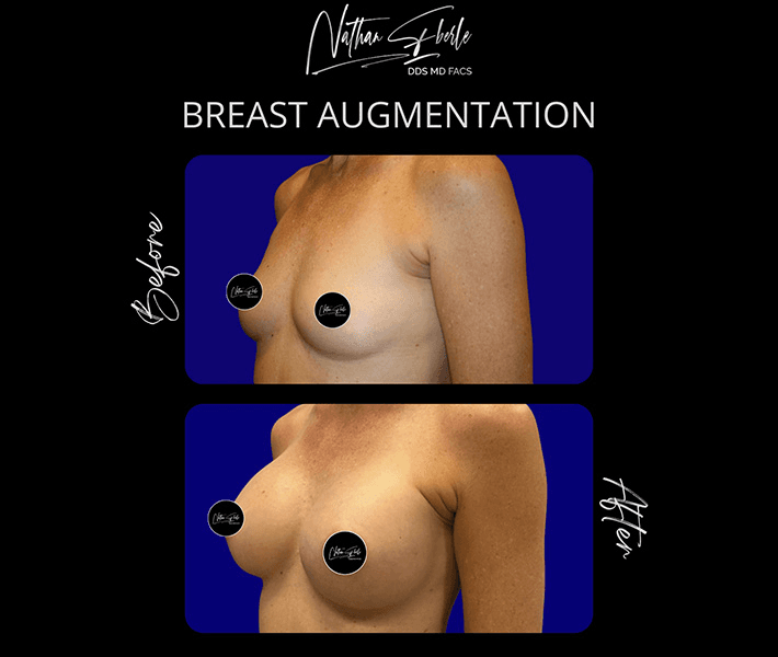 Breast Augmentation before and after case 298, actual patient at Weston Center for Plastic Surgery