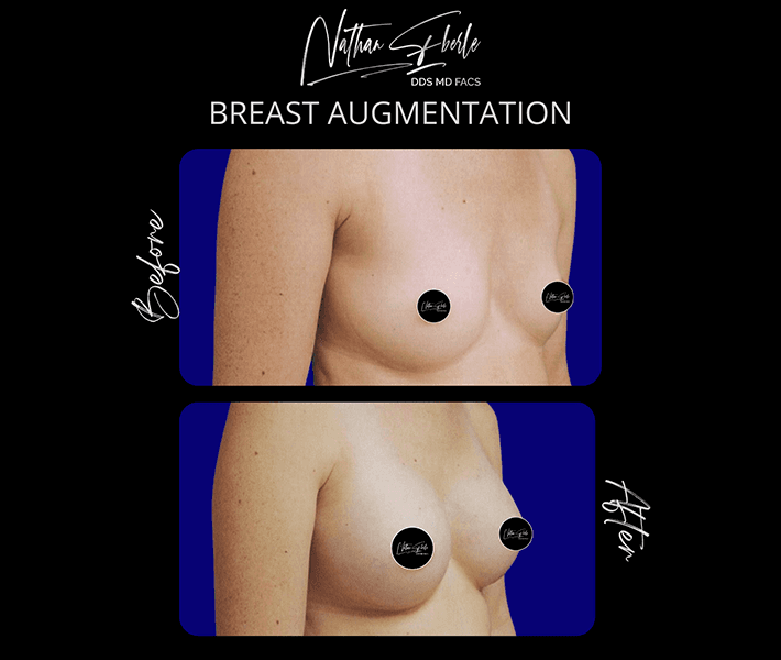 Breast Augmentation before and after case 3, actual patient at Weston Center for Plastic Surgery