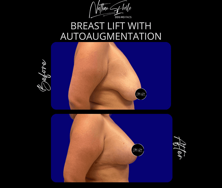 Breast Augmentation before and after case 302, actual patient at Weston Center for Plastic Surgery