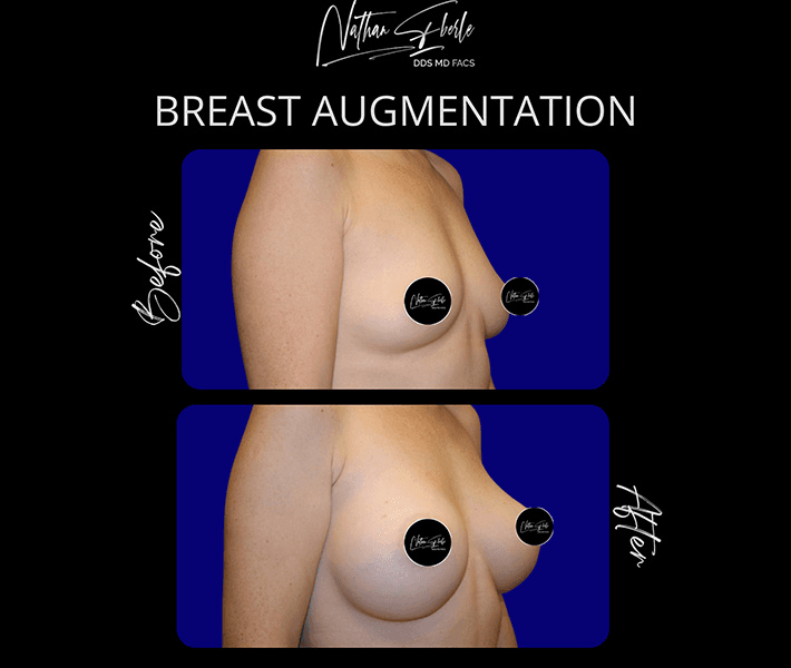 Breast Augmentation before and after case 303, actual patient at Weston Center for Plastic Surgery