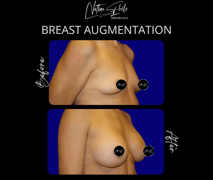 Breast Augmentation before and after case 309, actual patient at Weston Center for Plastic Surgery