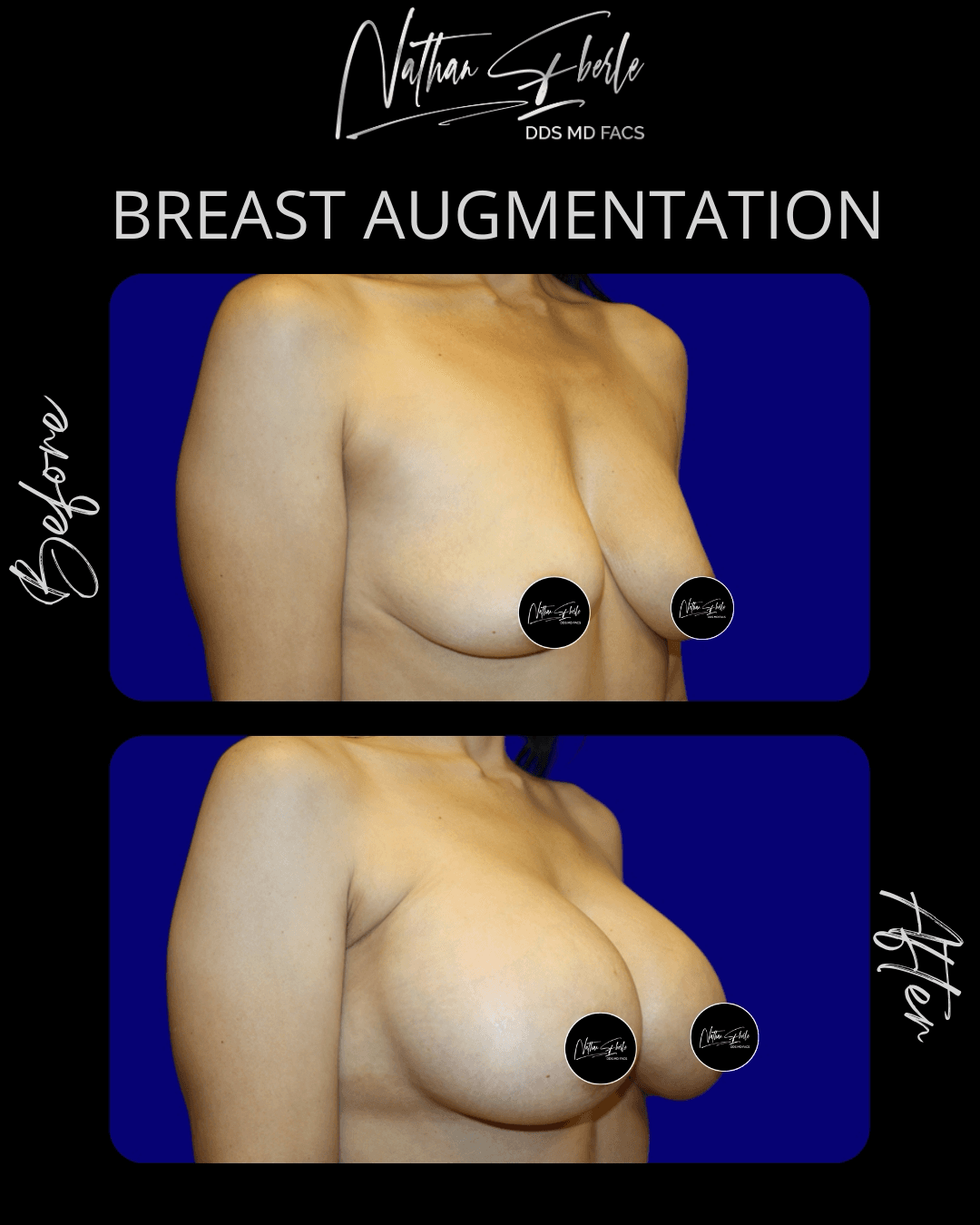 Breast Augmentation before and after case 31, actual patient at Weston Center for Plastic Surgery