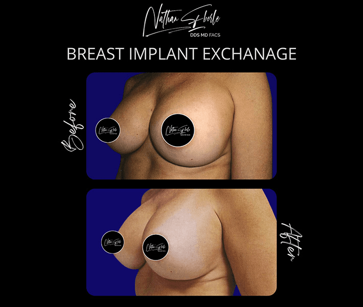 Breast Augmentation before and after case 312, actual patient at Weston Center for Plastic Surgery