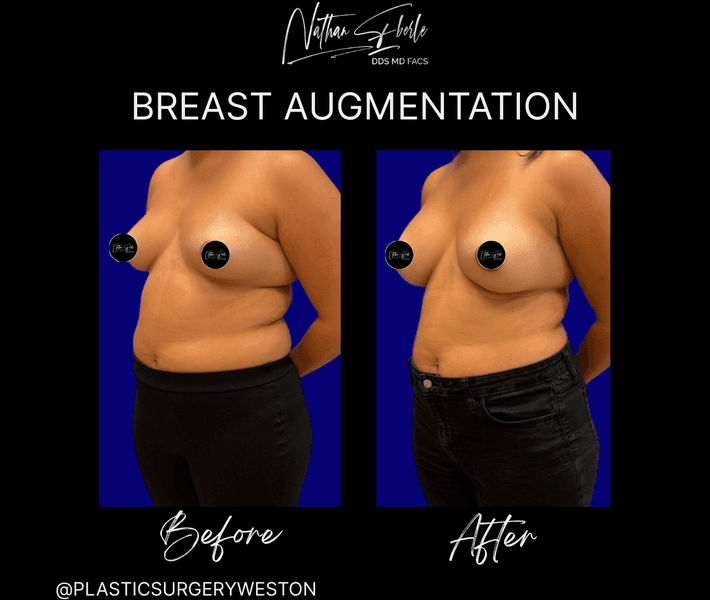 Breast Augmentation case 313 before and after results at Weston Center for Plastic Surgery