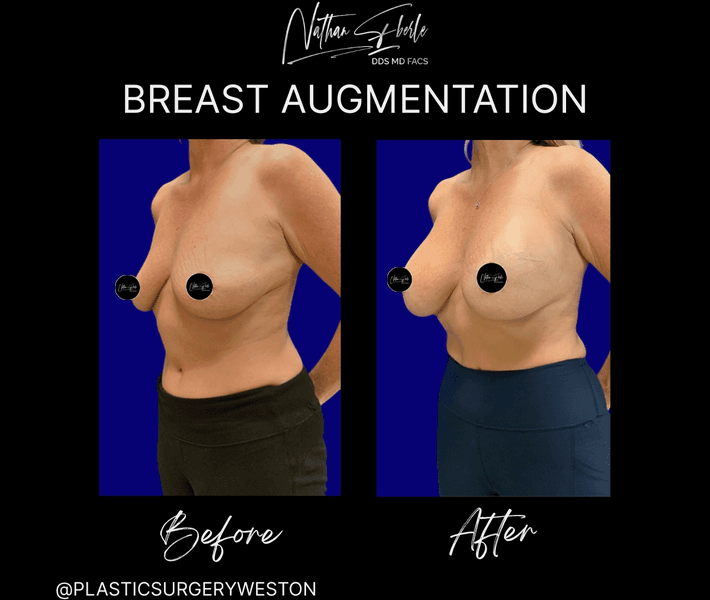 Breast Augmentation case 314 before and after results at Weston Center for Plastic Surgery