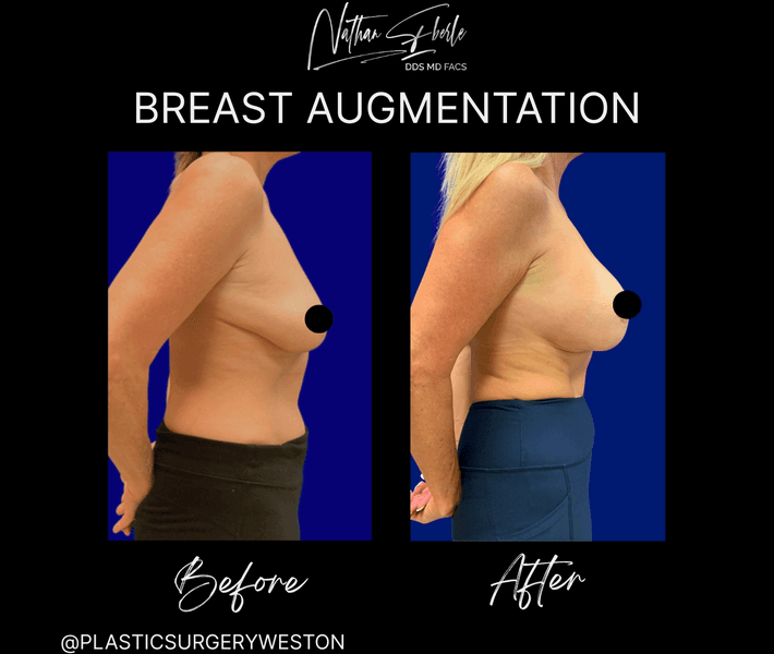 Breast Augmentation case 315 before and after results at Weston Center for Plastic Surgery