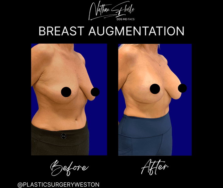 Breast Augmentation case 316 before and after results at Weston Center for Plastic Surgery