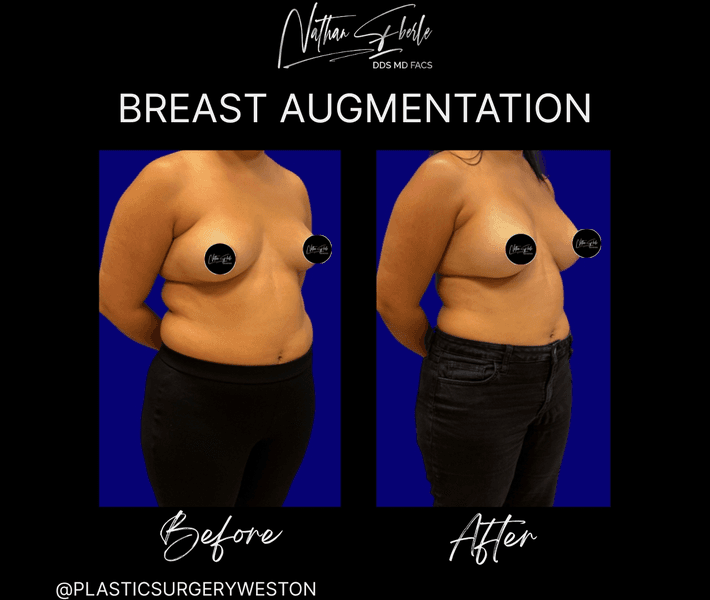 Breast Augmentation case 317 before and after results at Weston Center for Plastic Surgery