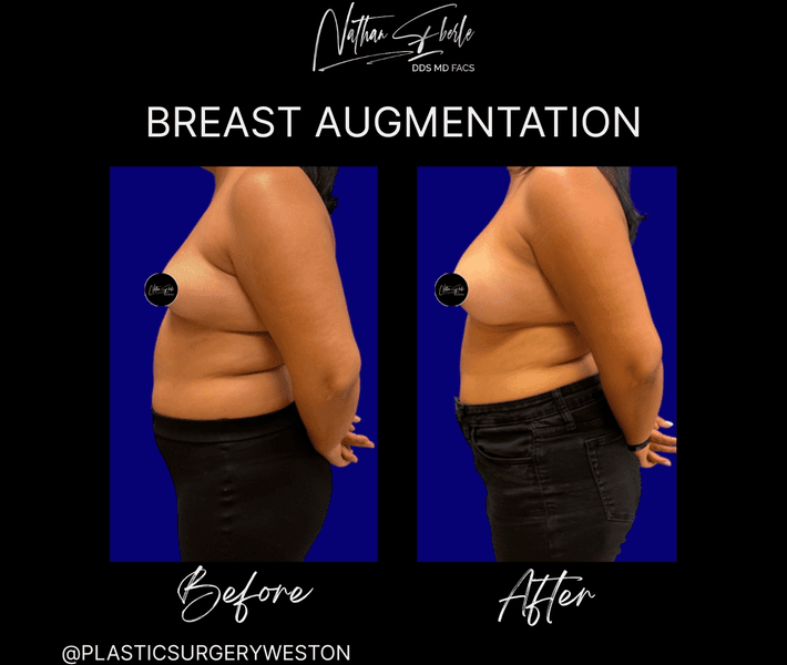 Breast Augmentation case 318 before and after results at Weston Center for Plastic Surgery