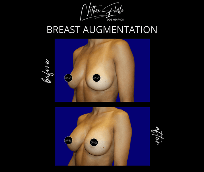 Breast Augmentation before and after case 36, actual patient at Weston Center for Plastic Surgery