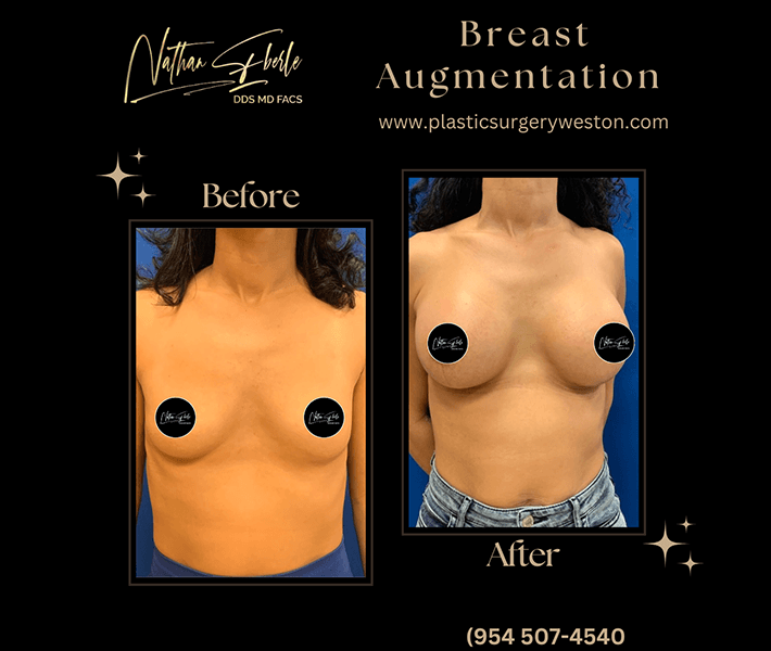 Breast Augmentation before and after case 39, actual patient at Weston Center for Plastic Surgery