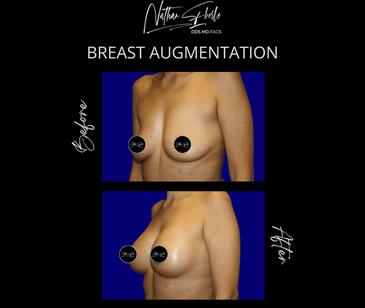 Breast Augmentation before and after case 49, actual patient at Weston Center for Plastic Surgery