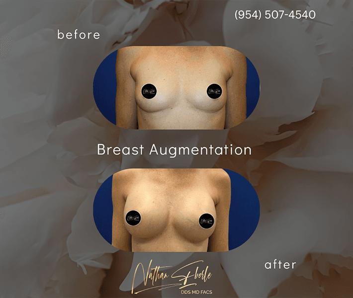 Breast Augmentation before and after case 50, actual patient at Weston Center for Plastic Surgery