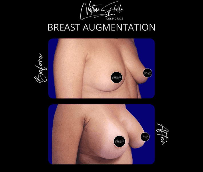 Breast Augmentation before and after case 53, actual patient at Weston Center for Plastic Surgery