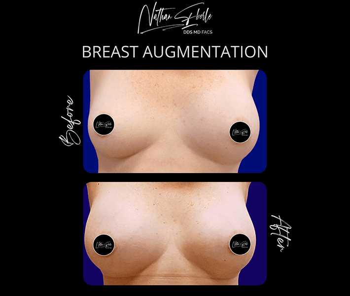 Breast Augmentation before and after case 55, actual patient at Weston Center for Plastic Surgery