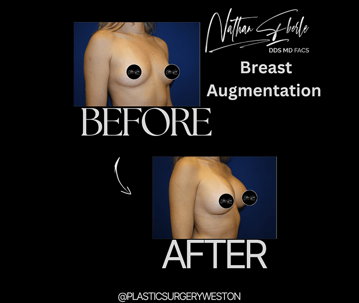 Breast Augmentation before and after case 60, actual patient at Weston Center for Plastic Surgery