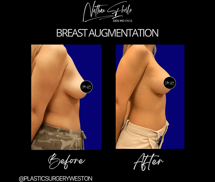 Breast Augmentation before and after case 64, actual patient at Weston Center for Plastic Surgery