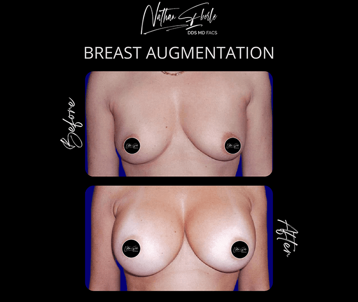 Breast Augmentation before and after case 7, actual patient at Weston Center for Plastic Surgery
