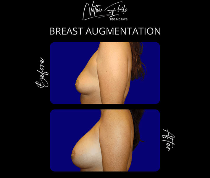 Breast Augmentation before and after case 72, actual patient at Weston Center for Plastic Surgery