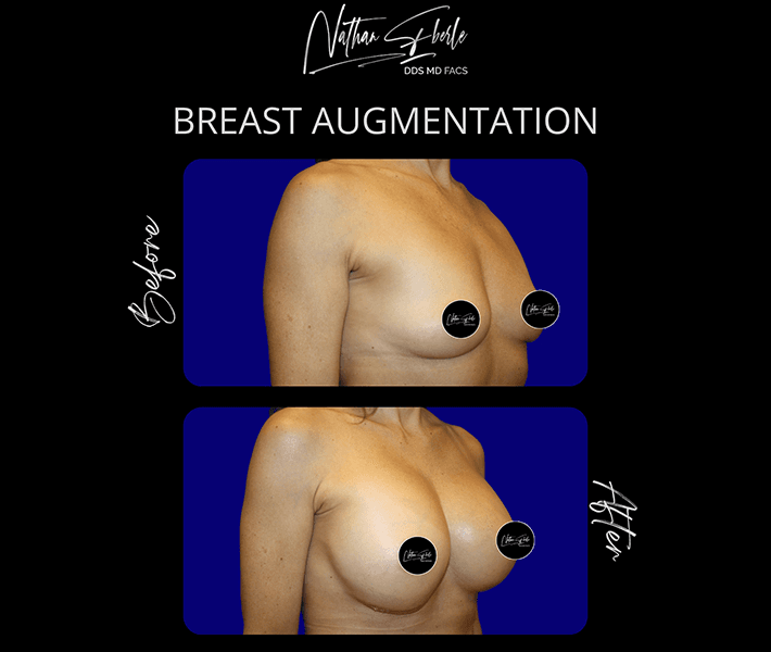 Breast Augmentation before and after case 73, actual patient at Weston Center for Plastic Surgery