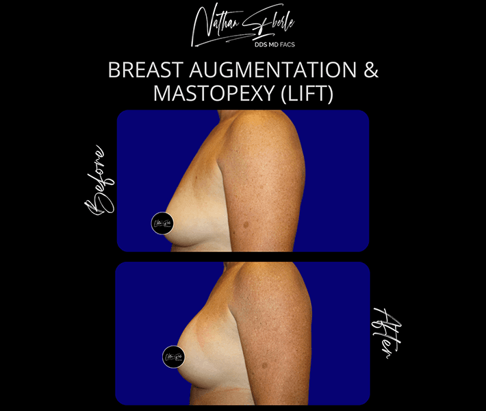 Breast Augmentation before and after case 77, actual patient at Weston Center for Plastic Surgery