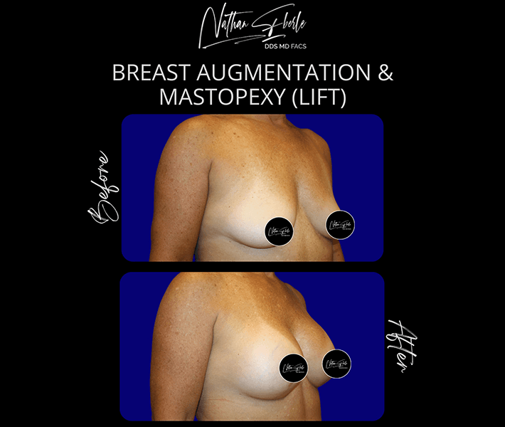 Breast Augmentation before and after case 79, actual patient at Weston Center for Plastic Surgery