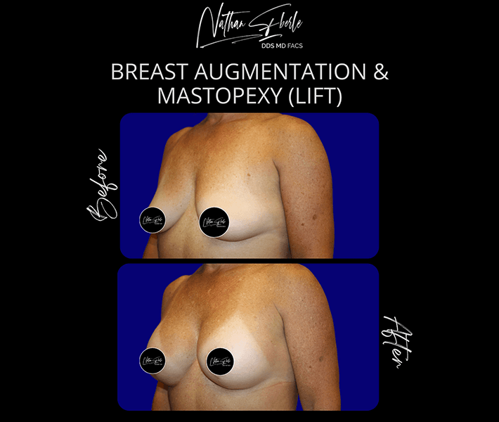 Breast Augmentation before and after case 81, actual patient at Weston Center for Plastic Surgery