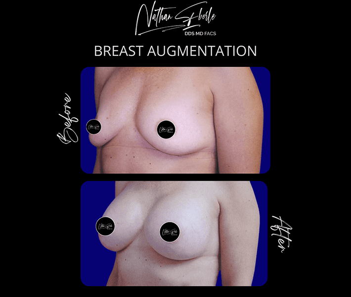 Breast Augmentation before and after case 86, actual patient at Weston Center for Plastic Surgery
