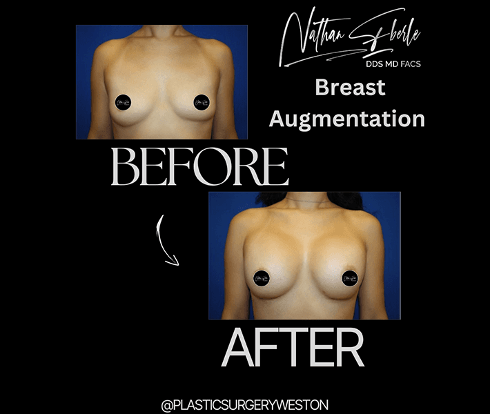 Breast Augmentation before and after case 87, actual patient at Weston Center for Plastic Surgery