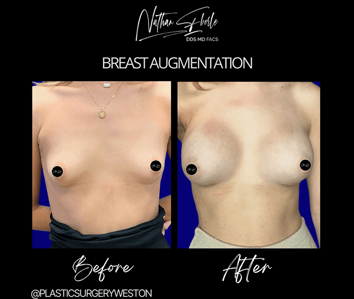Breast Augmentation before and after case 89, actual patient at Weston Center for Plastic Surgery