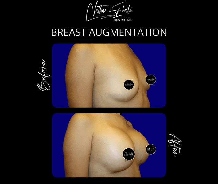Breast Augmentation before and after case 90, actual patient at Weston Center for Plastic Surgery
