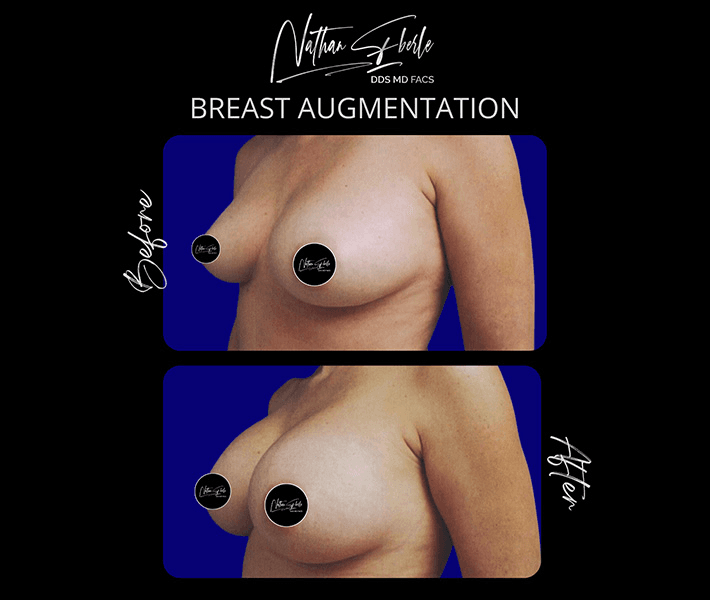 Breast Augmentation before and after case 95, actual patient at Weston Center for Plastic Surgery