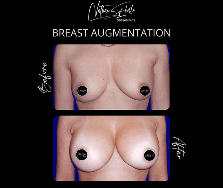 Breast Augmentation before and after case 97, actual patient at Weston Center for Plastic Surgery