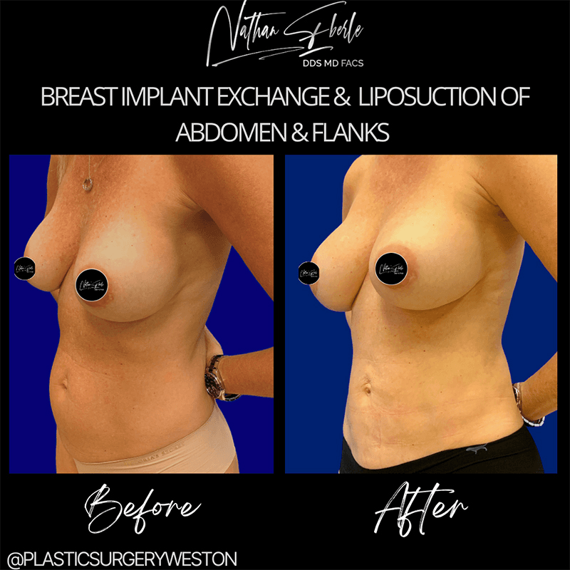Breast Implant Exchange case 1 before and after results at Weston Center for Plastic Surgery