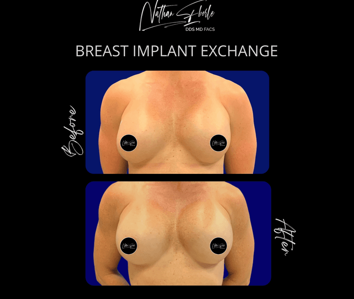 Breast Implant Exchange case 10 before and after results at Weston Center for Plastic Surgery